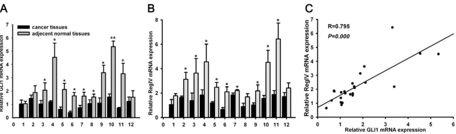 Figure 3. Expression of GLI1 and RegIV proteins was analyzed by IHC in PC and adjacent normal tissues