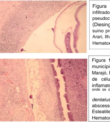 Figura  9.  Presença  de  fibroplasia  e  denso infiltrado  mononuclear  (1)  nas  margens  de  um  pseudocisto  contendo  Stephanurus  dentatus  (Diesing,  1839)  (2)  e  ovos  (setas)  no  ureter  de suíno  procedente  do  município  de  Cachoeira  do  A