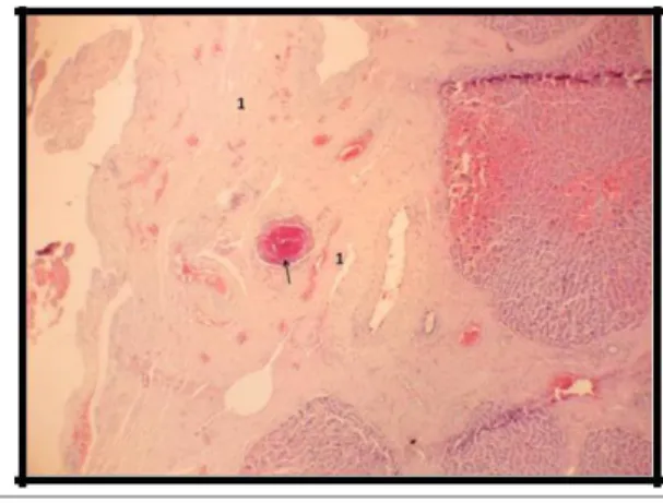 Figura 14.  Fígado de suíno procedente do município de Cachoeira do Arari, Ilha  de  Marajó,  Pará-Brasil,  com  reação  tipo  corpo  estranho  (linfócitos, macrófagos  e  células  gigantes)  (2)  à  Stephanurus  dentatus  (Diesing, 1839) (1) 