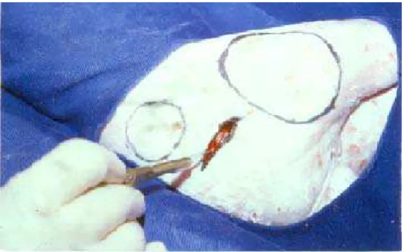 FIGURE 2 – Incision of skin over the mark.   
