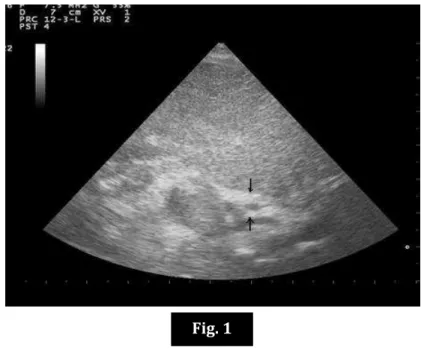 Fig.  1:  Sagittal  sonogram  shows  triangular  cord  sign  (arrow)  anterior  to  portal  vein  in  a  12  weeks  infant of biliary atresia