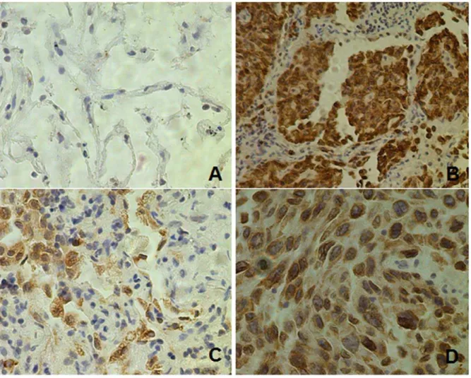 Figure 1. Representative images of immunohistochemical staining showing CLPTM1L is overexpressed in lung cancer relative to normal tissues