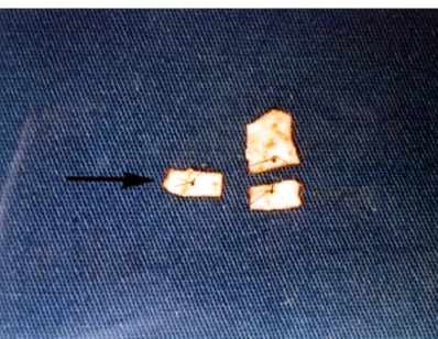 FIGURE  6 - Photograph showing the middle third of the surgical would, dislocated to the  left (arrow), which was used for examination under an optical microscope