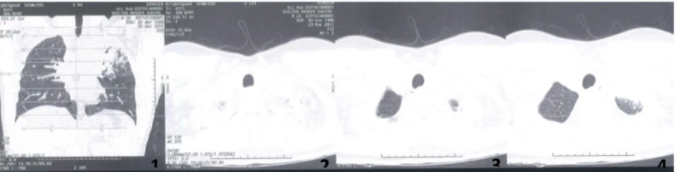 Figura A: Imagens da tomografia do tórax 