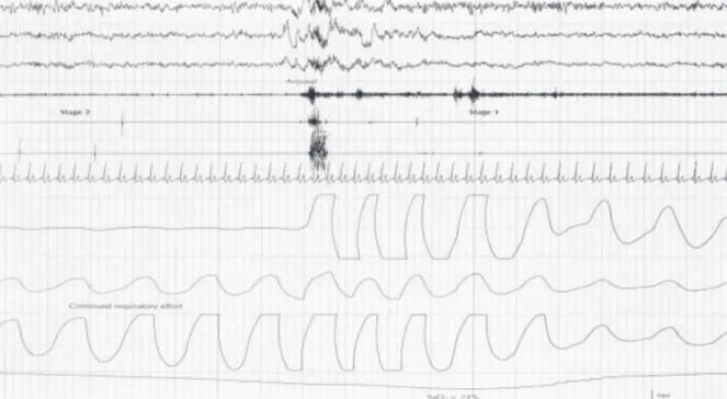 Figure 2 - P igure 2 - P igure 2 - P igure 2 - P igure 2 - Polysomnographic recording of obstructive sleep apnea