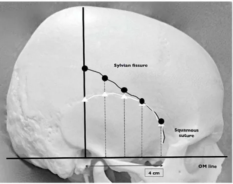 Figure 2. Interface of Osirix DICOM viewer for Sylvian fissure course analysis. a) Coronal view of default window/width level, which can show better visualization of the brain and vessels