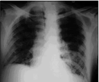 Fig 1. Chest radiograph, showing an area of consolidation on the left lower lobe.