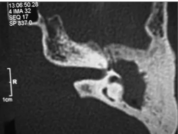 Figure 1. Left-side temporal bone CT scan, axial cross-section, sho- sho-wing blurred antrum and erosion of the lateral semicircular canal.