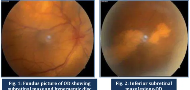 Fig. 2: Inferior subretinal  mass lesions-ODFig. 1: Fundus picture of OD showing 