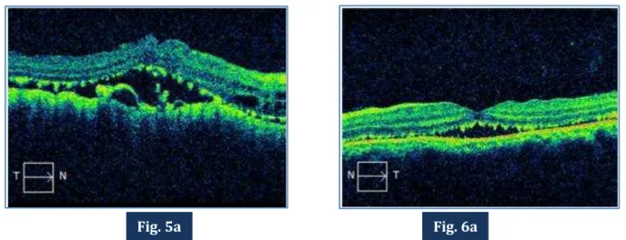 Fig.  5a  &amp;  6a:  OCT  of  OD  and  OS  showing  multiple  subretinal  and  choroidal  deposits  with  serous  retinal detachment