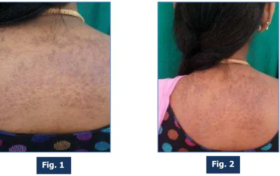 Fig.  1  &amp;  2:  Multiple warty brown papules and plaques, reticulate in appearance seen over upper  back