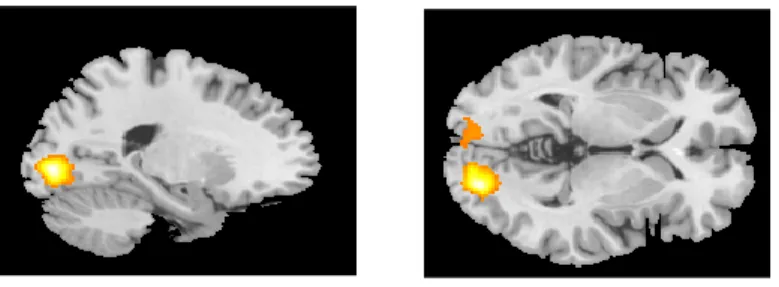 Figure 4. Sagittal and axial view of brain activity 