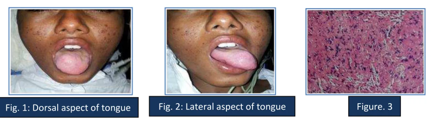 Fig. 1: Dorsal aspect of tongue  Fig. 2: Lateral aspect of tongue  Figure. 3 