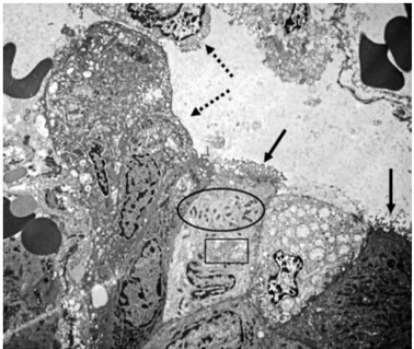 FIGURE 2. Small intestine transmission electron microscopy of an  HIV-infected child. Enterocytes with intense vacuolization