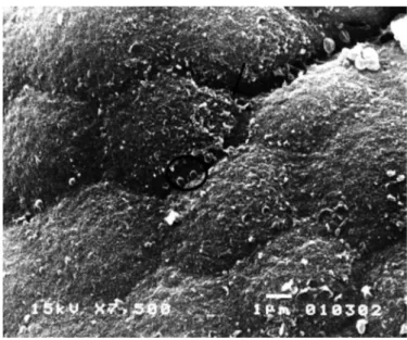 FIGURE 6. Small intestine scanning electronic microscopy of an HIV-in- HIV-in-fected child