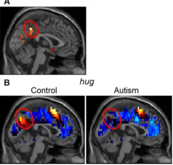 Figure 2. Posterior midline self factor location. A. Location of the voxels (circled) derived from the factor analysis of the Control Group that defined the posterior cingulate/precuneus sphere of this group’s self factor.