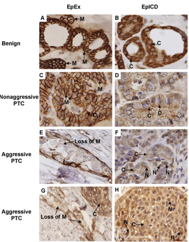 Figure 1. Immunohistochemical analysis of EpEx and Ep-ICD expression in papillary thyroid carcinomas and benign tissues
