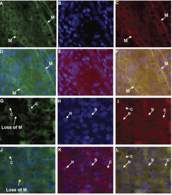 Figure 4. Fluorescence immunostaining with anti-EpEx and anti-Ep-ICD antibodies in aggressive and non-aggressive papillary thyroid carcinomas