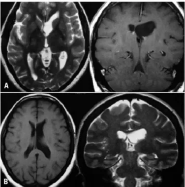 Fig 3. Unilateral hydrocephalus due to congenital stenosis of fo- fo-ramen of Monro. [A] Preoperative MRI; [B] Postoperative MRI.