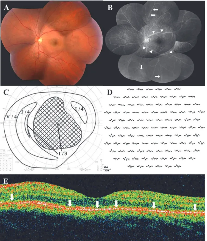 Fig 2. Photographs of the left eye at the initial visit in a 36-year-old male patient with AZOOR