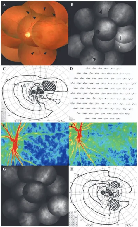 Fig 4. Photographs of the left eye before (A-E) and after (F-H) systemic corticosteroids therapy in a 39-year-old woman with AZOOR