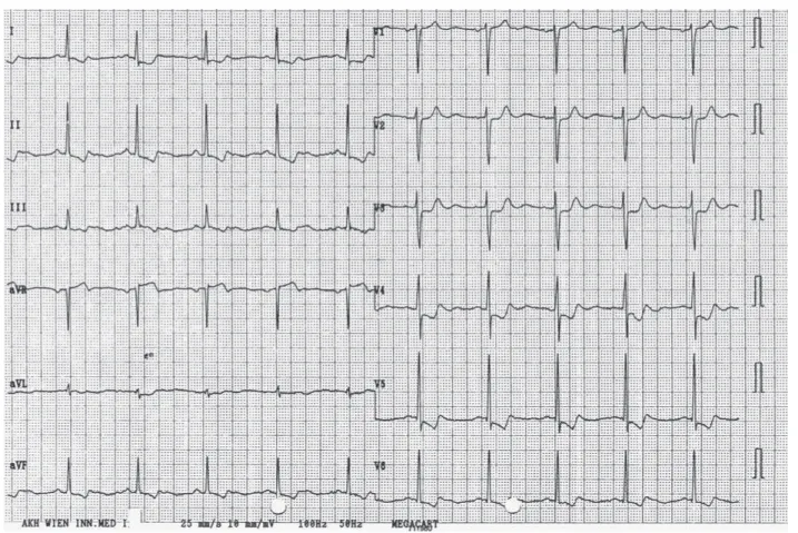 Abbildung 1: Ischämie im Anfalls-EKG  Torsade de pointes-Tachykardien