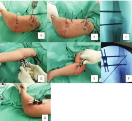 Fig. 1: Show  intra-operative  photographs  of  the  patient. (A) The  first  3.5  mm  Schanz  pin  was  inserted  at  the  distal  fragment  at  the metaphysis (DP) and a temporary 4 mm Schanz pin (TP) was inserted at the proximal 1/3rd of the humerus, ju