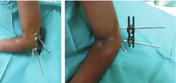 Fig. 4: Left elbow of a patient three weeks post-operative shows a combination of external fixator and Kirschner wire providing a stable fixation of the fracture site.