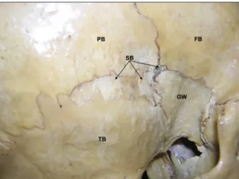 Figure 2.  Closer  view  of  the  pterion  with  the  sutural  bones.  ( PB: 
