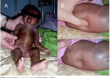 Figure 1. Photographs of the Patient Soon after Admission, Showing  Generalised Oedema