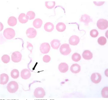Figure 3. Thin Blood Film of the Patient Showing Five Trypanosomes  and Several Red Blood Cells