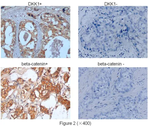 Figure 2. Cytoplasmic immunostaining of DKK1 and beta-catenin in carcinomas. A) Positive immunostaining of DKK1 in an invasive ductal breast carcinoma, 6 400 magnification