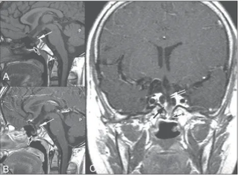 Fig 3. MRI images of the sagittal plane on  T1 without iodine contrast (A), sagittal with  iodine contrast (B) and coronal with iodine  contrast (C) showing the hypophysis in the  inner sella (black arrow)