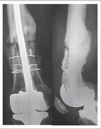 Abbildung 1: Röntgenbilder eines 58jährigen Patienten, der im Juni 1996 bei Gonarthrose mit Kniegelenksprothese versorgt wurde
