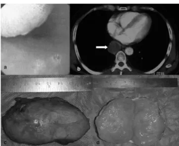 Figure 1. Endoscopic appearance of mass (A), Mass appearance in computerized  tomography (B), Appearance of mass (C, D).
