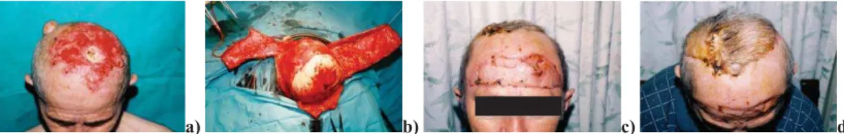 Fig. 1 – a) Clinical manifestation of infiltrative basal cell carcinoma; b) Intracranial propagation of the tumor and “Banana Peel” lifted flaps and reconstructed secondary defect by Orticochea; c) Front view; d) Top view.