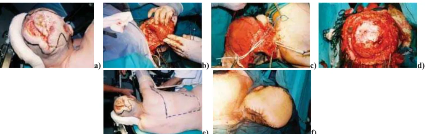 Fig. 2 – a) Clinical manifestation of infiltrated basal cell carcinoma (ulcus terebrans); b) Marked lines represent the site of delamination of free microvascular latissimus dorsi flap; c) Clear invasion of carcinoma into the tissue (which is much larger