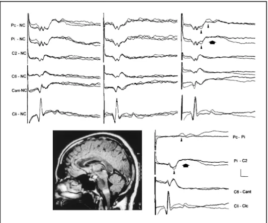 Fig 1. The left group of curves displays the responses evoked after stimulation of the right median nerve