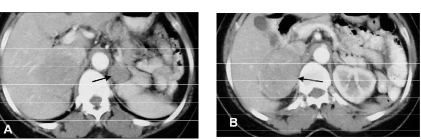 Figure 10. Multiple pheochromocytomas in MEN2b. A and B: CT shows bilateral heterogeneous adrenal tumors (arrows).