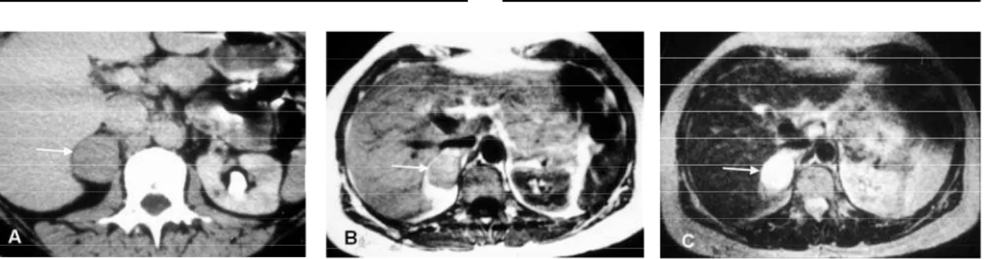 Figure 12. Pheochromocytoma in a man with episodic hypertensive crises. A: Homogeneous right adrenal mass on CT image (arrow)