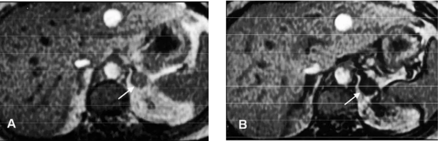 Figure 14. MRI on Left Adrenal Adenoma. A: T1-weighted GRE image done during suspended respiration shows a 2.0cm no- no-dule in the right adrenal (arrow) with signal intensity similar to liver