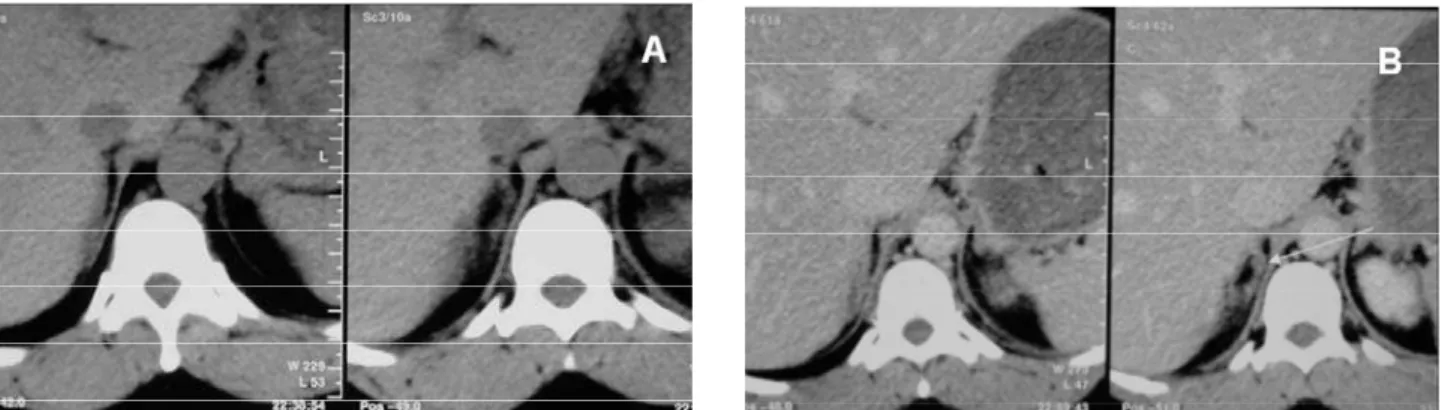 Figure 1. Use of thinner collimation. A: CT with 7mm contiguous sections demonstrates an equivocal right adrenal nodule.