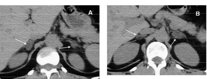 Figure 3. Nodular hyperplasia – Diffuse nodular thickening of the adrenal glands (arrows).