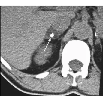 Figure 5. Cushing’s syndrome due to a cortical adenoma.