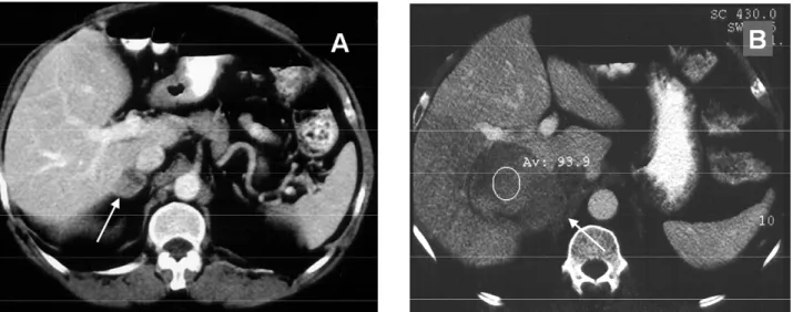 Figure 7. Carcinoma of the Right Adrenal. A: Initial examination shows small nodule of the right adrenal gland (arrow), erro- erro-neously diagnosed as an adenoma