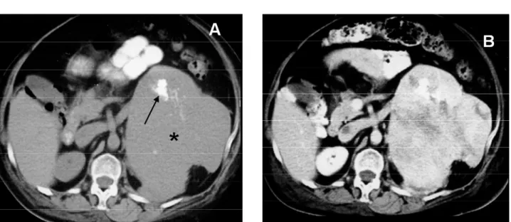 Figure 8. Adrenal carcinoma. A: Precontrast CT shows a heterogeneous 8cm left adrenal mass (*) containing a small amount of calcification (arrow)