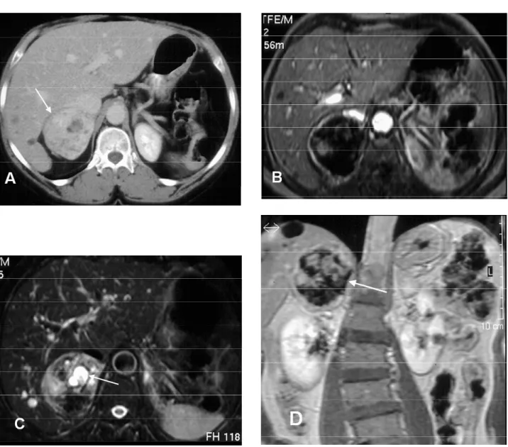 Figure 9. Cushing’s syndrome due to adrenal carcinoma. A: Post-contrast CT shows a heterogeneous right adrenal mass (arrow) with non-enhancing area