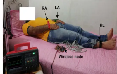 Figure 14 : ECG Measurement for One  Patient 