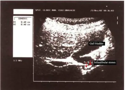 Figure 1. The ultrasonographic image of the folded gall bladder with the stones of 4 mm  each in the bladder infundibulum