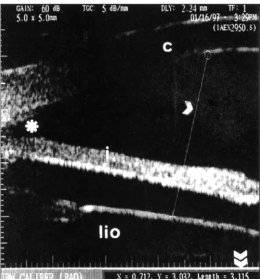 Fig. 1 - Longitudinal ultrasound biomicroscopy examination (UBM with 50 MHz transducer, under immersion)